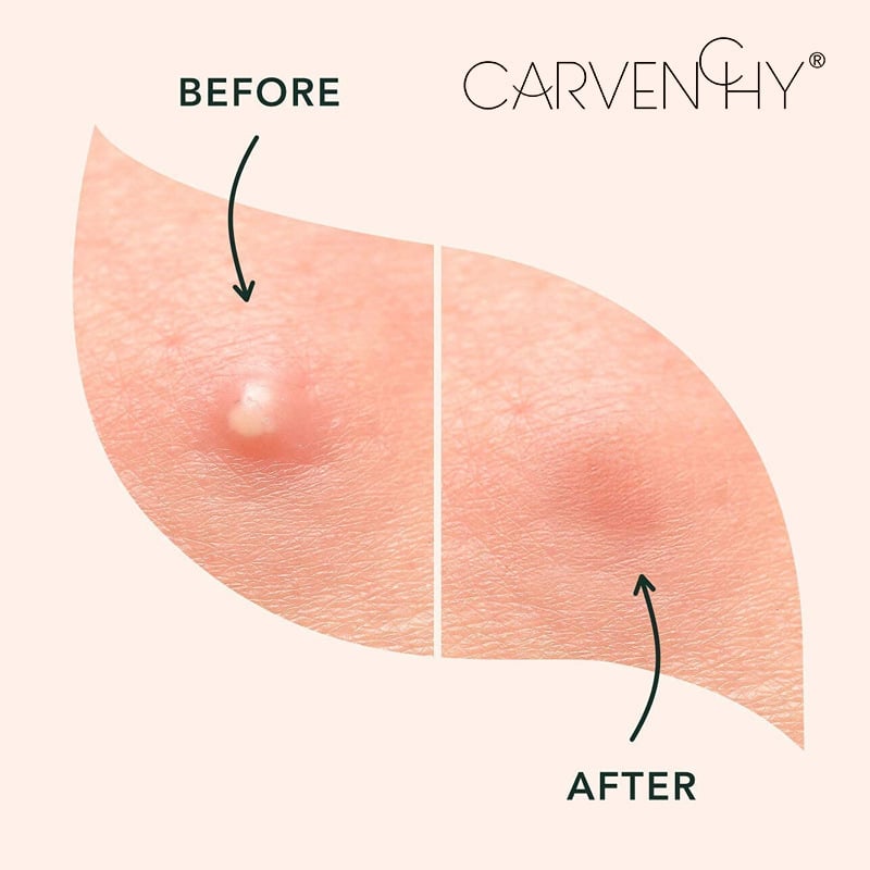 MIRACLE PATCH Hydrocolloid Acne Stickers Waterproof Invisible Ultra-Thin for Blemish Treatment (96 Patches)